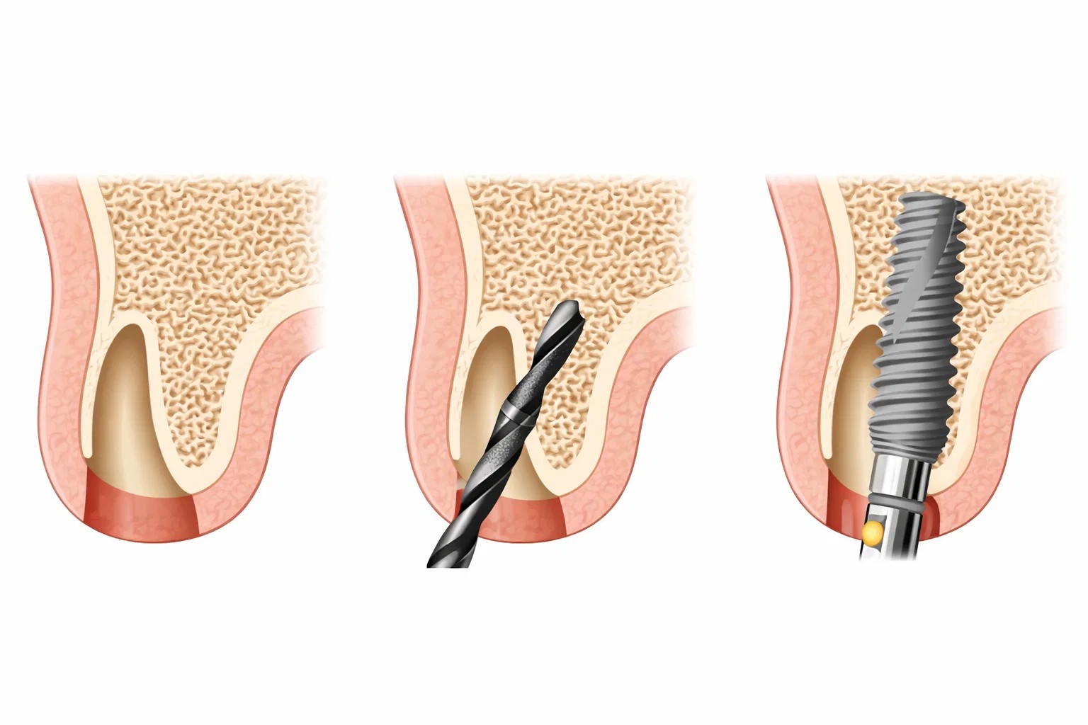 immediate implant concept